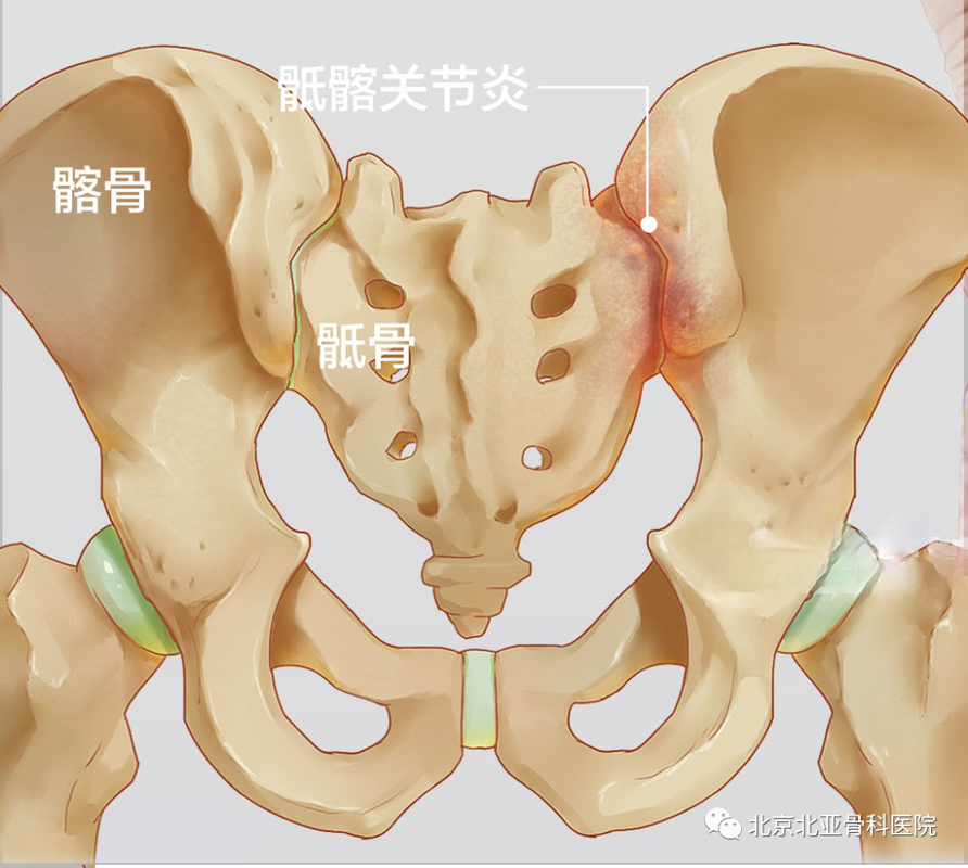 髂-女性为什么得了骶髂关节炎